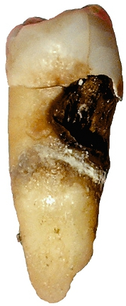 Illustration for article titled A Vaccine That Could Protect Against Tooth Decay?